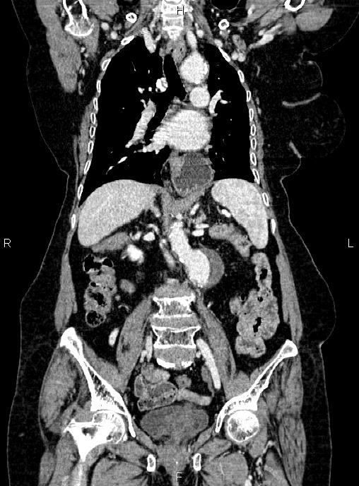 Abdominal aortic aneurysm (Radiopaedia 85063-100606 Coronal C+ arterial phase 31).jpg