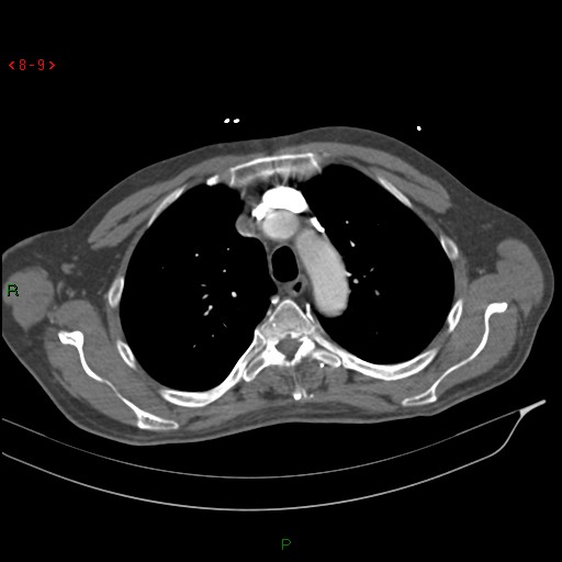 Abdominal aortic aneurysm rupture with aortocaval fistula (Radiopaedia 14897-14841 Axial C+ arterial phase 9).jpg