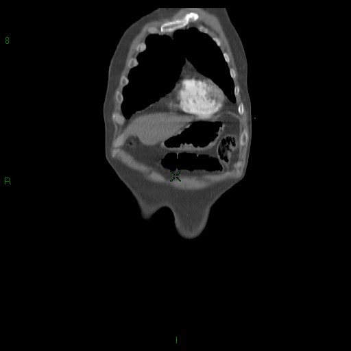 File:Abdominal aortic aneurysm rupture with aortocaval fistula (Radiopaedia 14897-14841 Coronal C+ arterial phase 14).jpg