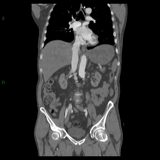 File:Abdominal aortic aneurysm rupture with aortocaval fistula (Radiopaedia 14897-14841 Coronal C+ arterial phase 26).jpg