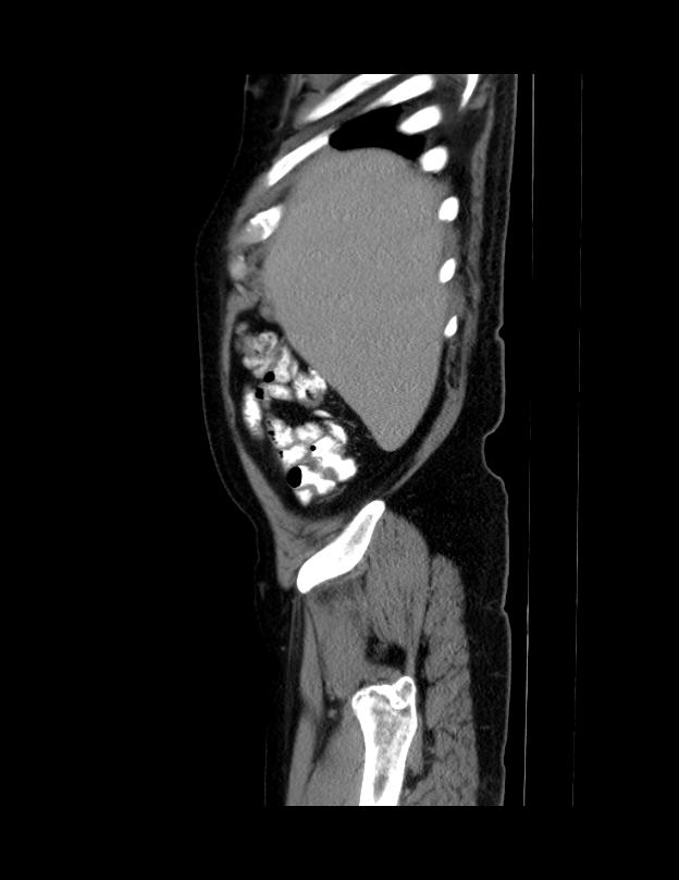 Abdominal lymphoma - with sandwich sign (Radiopaedia 53486-59492 Sagittal C+ portal venous phase 70).jpg