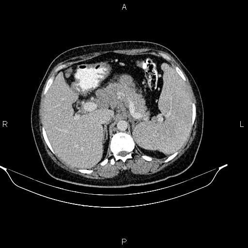 File:Abdominal lymphoma with sandwich sign (Radiopaedia 84378-99704 Axial C+ portal venous phase 15).jpg