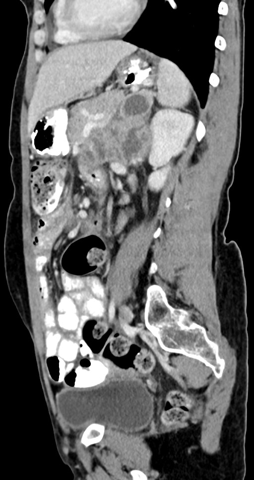 Abdominal wall and retroperitoneal tuberculosis (Radiopaedia 88137-104729 Sagittal C+ portal venous phase 59).jpg