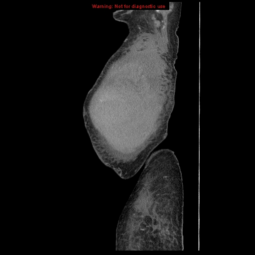 File:Abdominal wall hematoma (Radiopaedia 9427-10112 Sagittal C+ portal venous phase 106).jpg