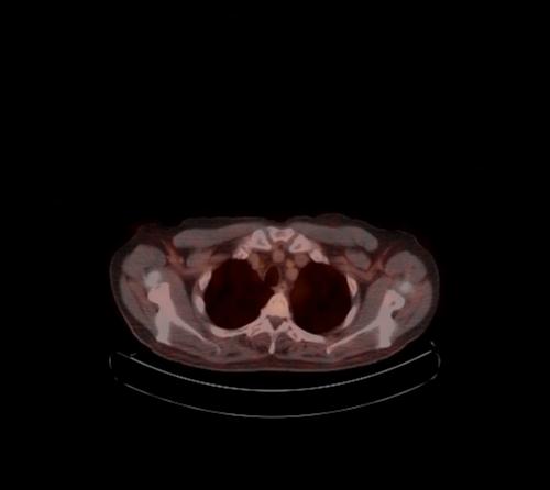 Abdominal wall metastasis from colorectal carcinoma (Radiopaedia 31016-31719 C 122).jpg