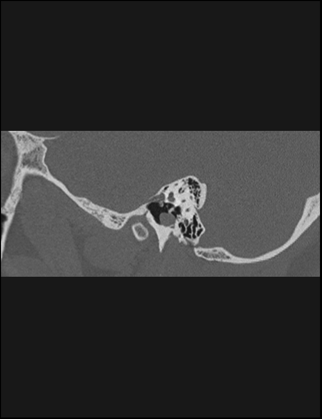 Aberrant right internal carotid artery (Radiopaedia 65191-74198 Sagittal non-contrast 48).jpg