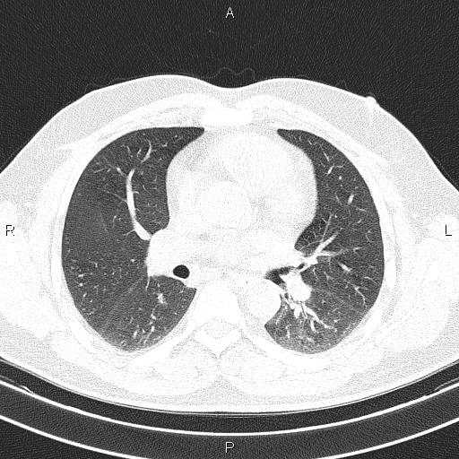 File:Aberrant right subclavian artery (Radiopaedia 87093-103354 Axial lung window 54).jpg