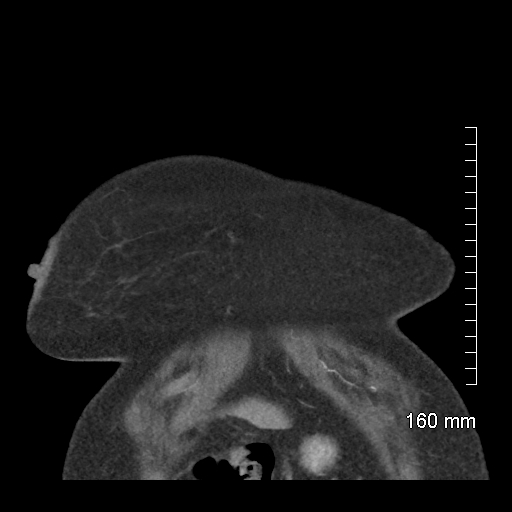Aberrant right subclavian artery stenosis (Radiopaedia 52656-58670 B 11).jpg