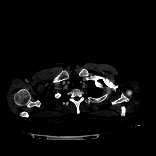 File:Accesory rib joint (Radiopaedia 71987-82452 Axial bone window 90).jpg