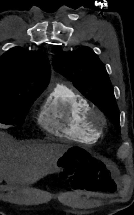 Accessory left atrial appendage (Radiopaedia 81987-95968 Coronal C+ arterial phase 7).jpg