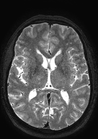 Accessory middle cerebral artery (Radiopaedia 73114-83828 Axial T2 61).jpg