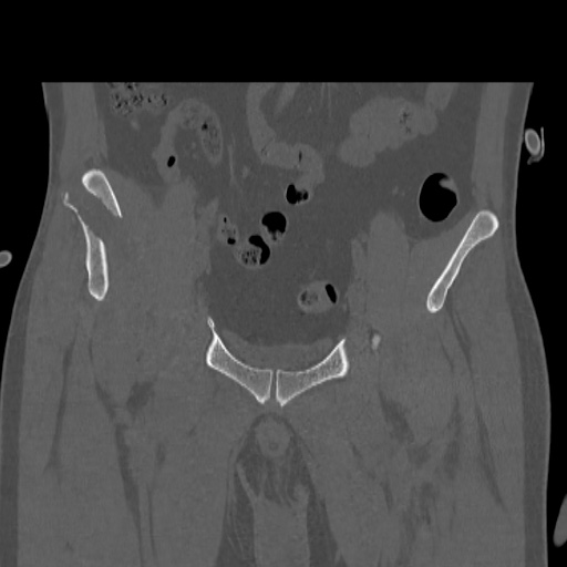 Acetabular and ilial fractures (Radiopaedia 59084-66378 Coronal bone window 15).jpg