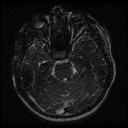 File:Acoustic schwannoma (Radiopaedia 33045-34060 Axial T2 63).png