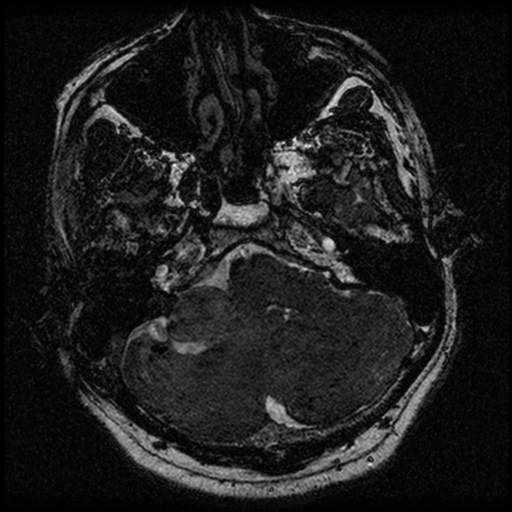 File:Acoustic schwannoma (Radiopaedia 39170-41387 Axial FIESTA 51).png