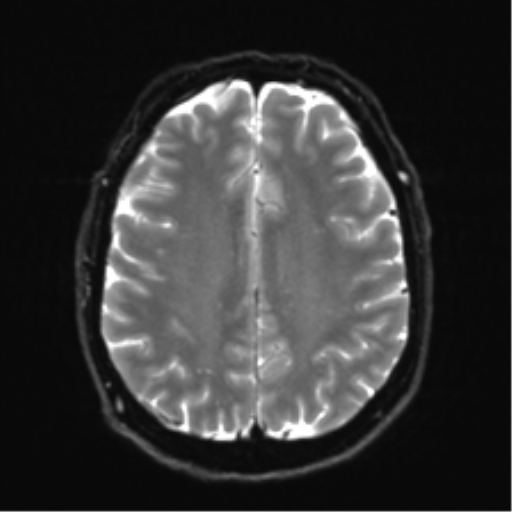 Acoustic schwannoma (Radiopaedia 50846-56358 Axial DWI 21).png