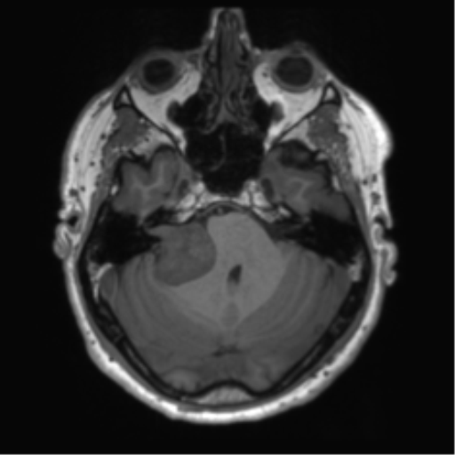File:Acoustic schwannoma (Radiopaedia 50846-56358 Axial T1 24).png