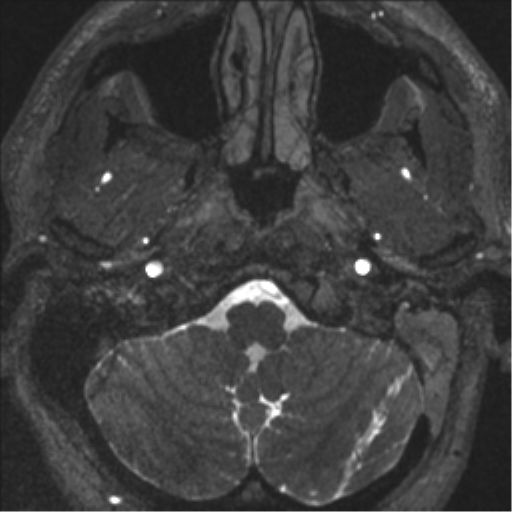 Acoustic schwannoma (translabyrinthine resection) (Radiopaedia 43570-46972 Axial CISS 5).png