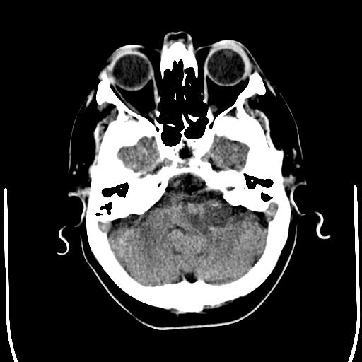 File:Acoustic schwannoma - cystic (Radiopaedia 29487-29980 AXIAL THICK non-contrast 6).jpg