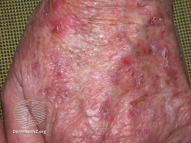 File:Actinic Keratoses treated with imiquimod (DermNet NZ lesions-ak-imiquimod-3744).jpg