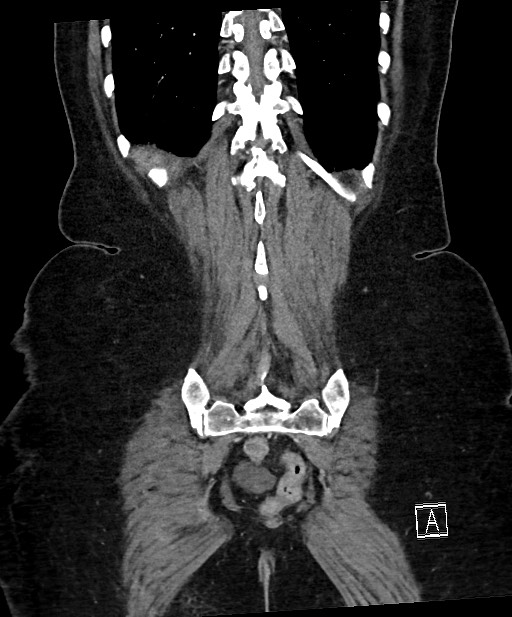 Active Crohn disease (Radiopaedia 59394-66750 Coronal C+ portal venous phase 59).jpg