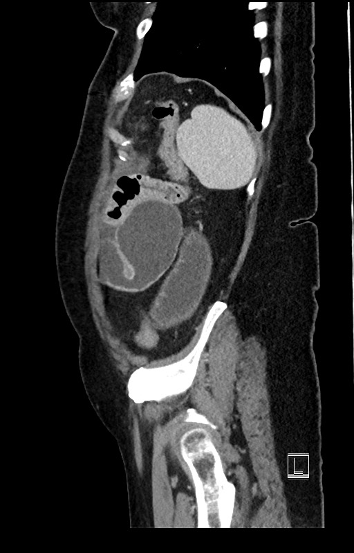 Active Crohn disease (Radiopaedia 59394-66750 Sagittal C+ portal venous phase 10).jpg