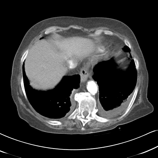 File:Active bleeding from duodenal ulcer with embolization (Radiopaedia 34216-35481 Axial C+ arterial phase 11).png