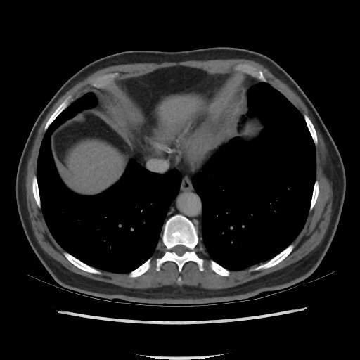 File:Active colonic bleed on CT (Radiopaedia 49765-55025 Axial C+ delayed 8).jpg