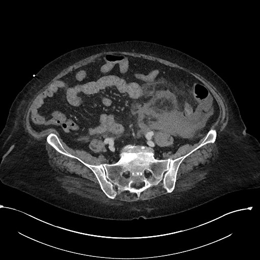 File:Active renal extravasation with large subcapsular and retroperitoneal hemorrhage (Radiopaedia 60975-68796 Axial 254).jpg