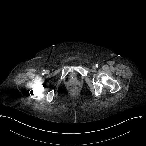 Active renal extravasation with large subcapsular and retroperitoneal hemorrhage (Radiopaedia 60975-68796 Axial C+ arterial phase 196).jpg