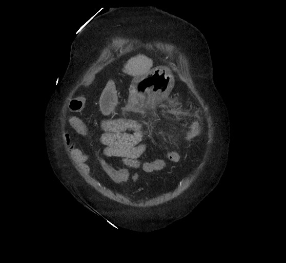 Active renal extravasation with large subcapsular and retroperitoneal hemorrhage (Radiopaedia 60975-68796 Coronal C+ arterial phase 31).jpg