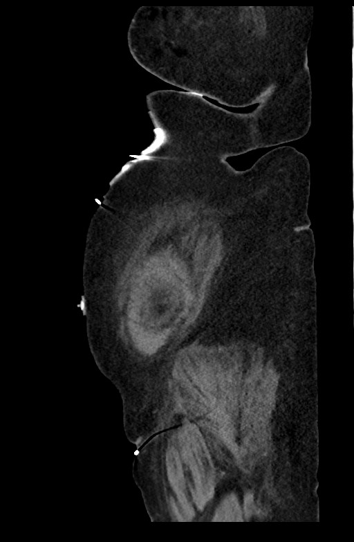 Active renal extravasation with large subcapsular and retroperitoneal hemorrhage (Radiopaedia 60975-68796 Sagittal C+ portal venous phase 38).jpg