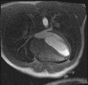 Active right ventricular cardiac sarcoidosis (Radiopaedia 55596-62100 Axial Dynamic perfusion scan MOCO 73).jpg
