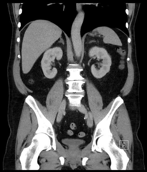 Acute-on-chronic pancreatitis (Radiopaedia 67286-76656 Coronal C+ portal venous phase 47).jpg