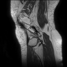 Acute-on-chronic transient lateral patellar dislocation with trochlear dysplasia (Radiopaedia 84099-99349 Sagittal PD 137).jpg