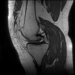 Acute-on-chronic transient lateral patellar dislocation with trochlear dysplasia (Radiopaedia 84099-99349 Sagittal PD 67).jpg