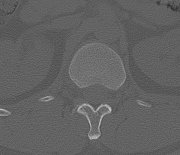 File:Acute L1 burst compression fracture (Radiopaedia 34430-35755 Axial bone window 15).png