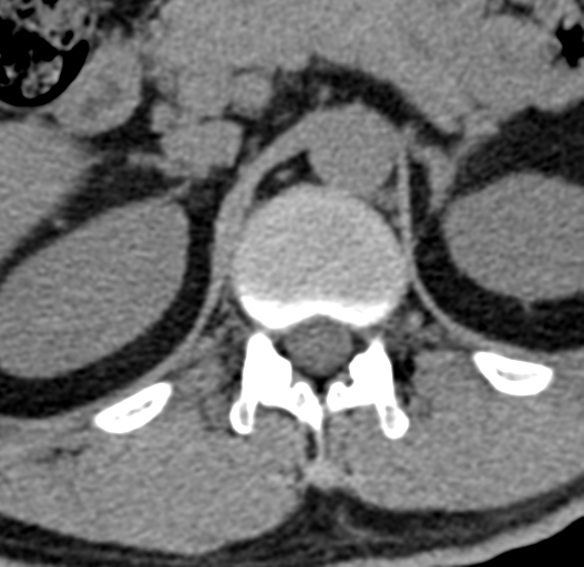 File:Acute L1 burst compression fracture (Radiopaedia 34430-35755 Axial non-contrast 7).png