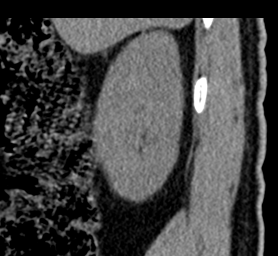 File:Acute L1 burst compression fracture (Radiopaedia 34430-35755 E 101).png