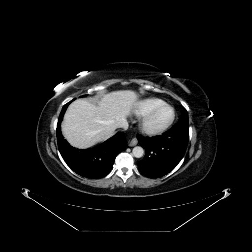 Acute appendicitis, heterotaxy syndrome (Radiopaedia 66884-76202 Axial C+ portal venous phase 16).jpg