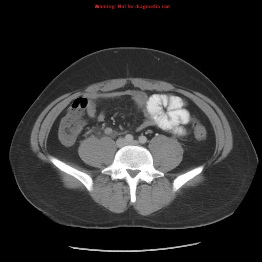Acute appendicitis (Radiopaedia 10498-10973 Axial C+ portal venous phase 15).jpg