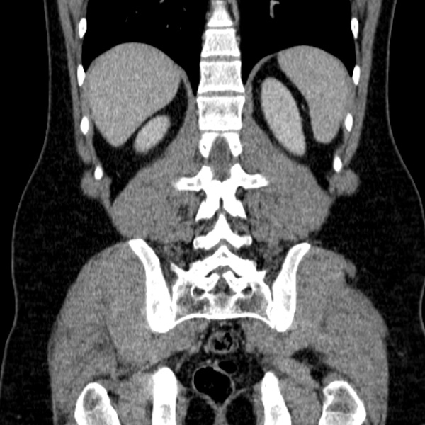 Acute appendicitis (Radiopaedia 38255-40270 Coronal C+ portal venous phase 65).jpg