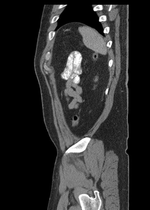 Acute appendicitis (Radiopaedia 48511-53463 Sagittal C+ portal venous phase 112).jpg