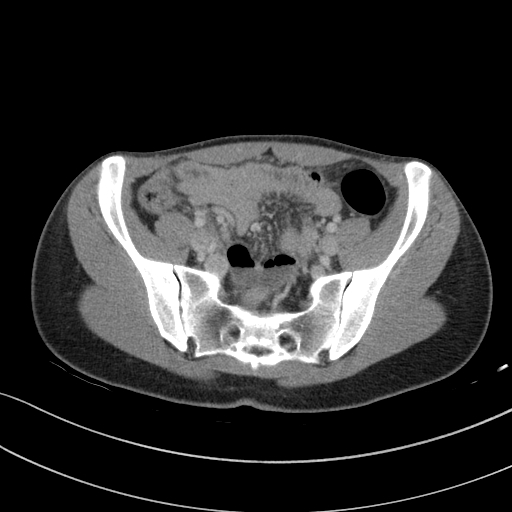 Acute appendicitis (Radiopaedia 62608-70901 Axial C+ portal venous phase 20).jpg