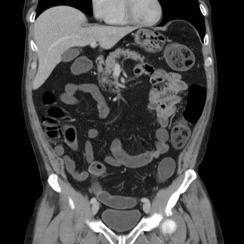 Acute appendicitis (Radiopaedia 66513-75790 Coronal C+ portal venous phase 26).jpg