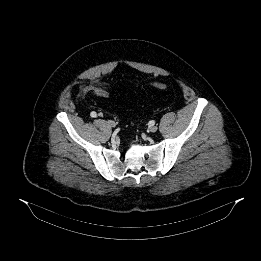 File:Acute appendicitis (Radiopaedia 79950-93224 Axial C+ portal venous phase 82).jpg