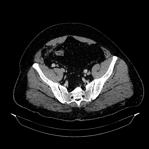 Acute appendicitis (Radiopaedia 79950-93224 Axial C+ portal venous phase 83).jpg
