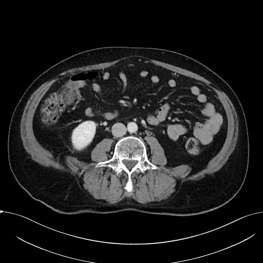 Acute appendicitis - large appendicoliths (Radiopaedia 61805-69820 Axial C+ portal venous phase 70).jpg