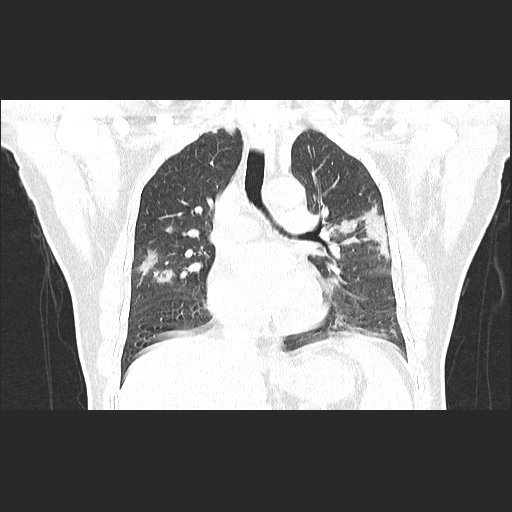 Acute appendicitis and COVID 19 pneumonia (Radiopaedia 76604-88380 G 33).jpg