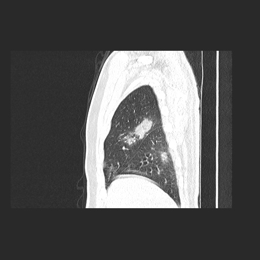 Acute appendicitis and COVID 19 pneumonia (Radiopaedia 76604-88380 Sagittal lung window 18).jpg