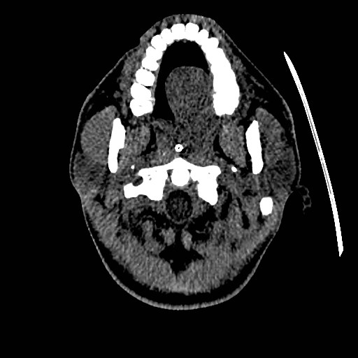 Acute basilar artery occlusion (Radiopaedia 43582-46985 Axial non-contrast 17).jpg